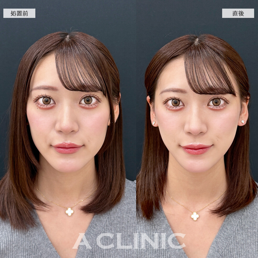 Aスレッドで口元のもたつきが直後からスッキリ！こちら処置前と直後の症例です(20代女性)