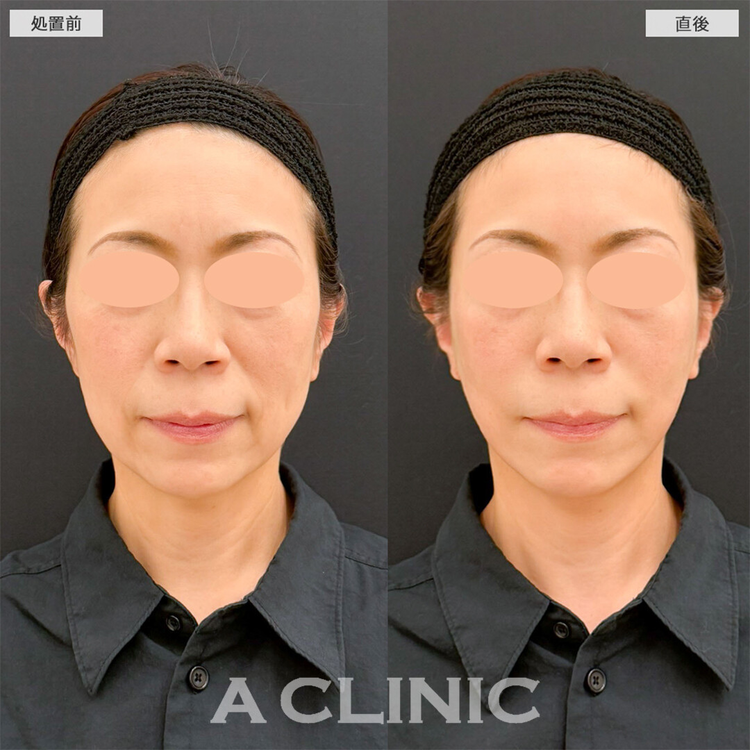 Aスレッドで口横たるみが無くなり綺麗な卵形輪郭へ！こちら処置前と直後の症例です(50代女性)
