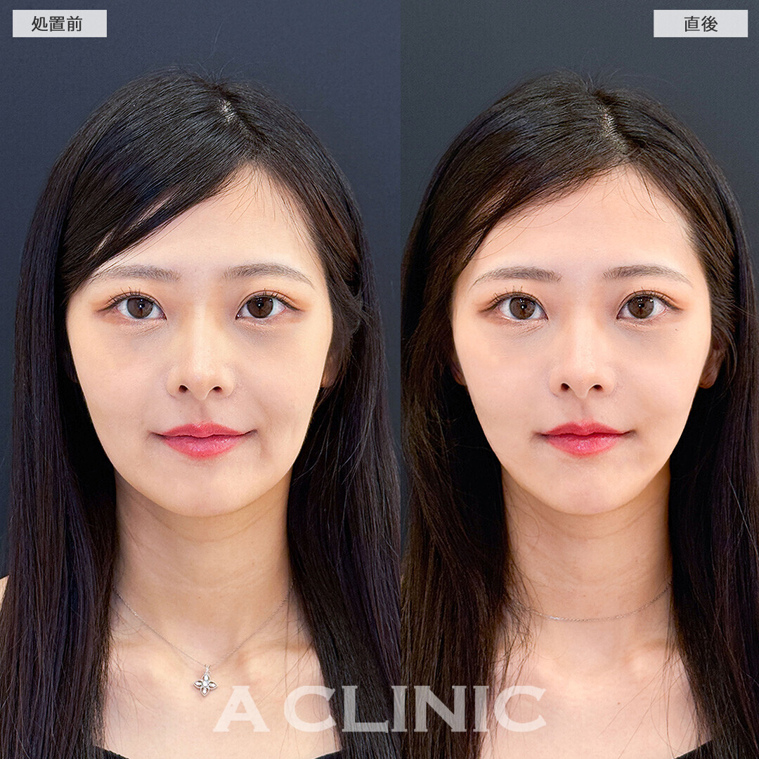 Aスレッドで口横のもたつきがスッキリ改善！こちら処置前と直後の症例です(20代女性)