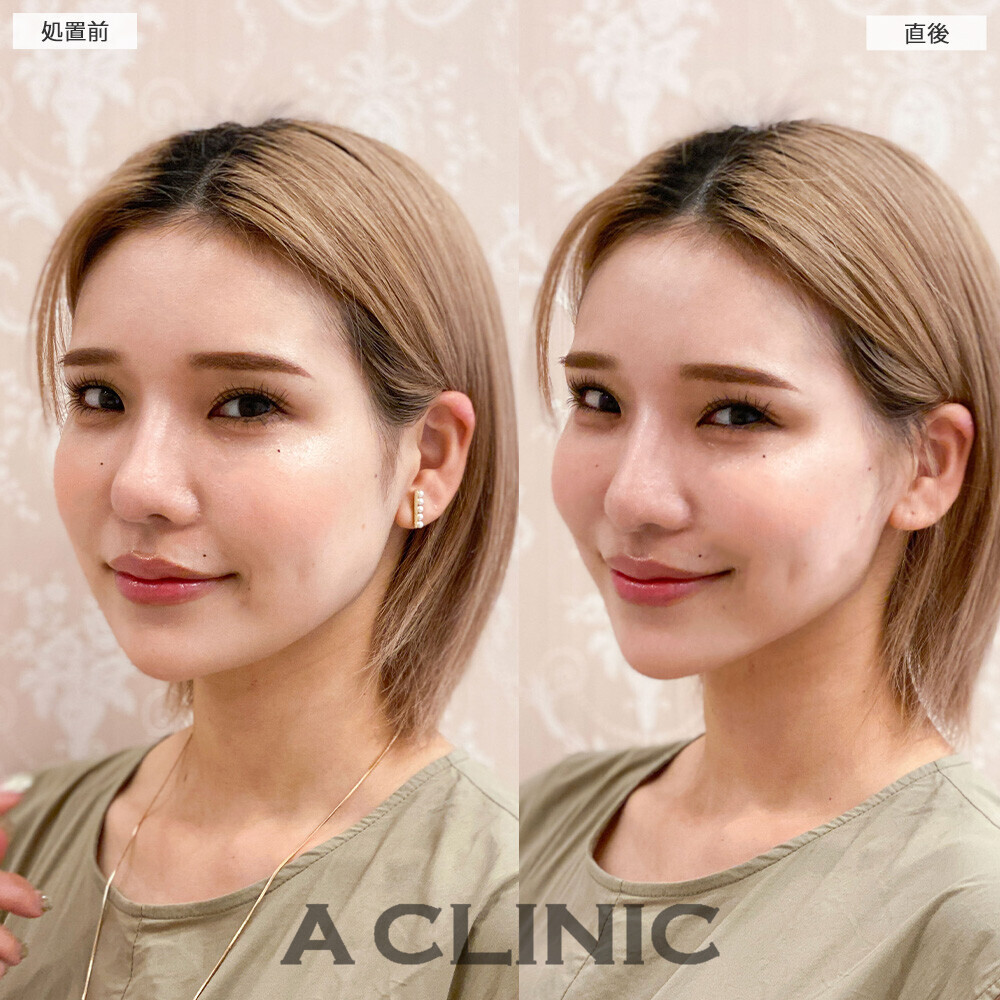 Aスレッドで丸顔改善！こちら処置前と直後の症例です(30代女性)