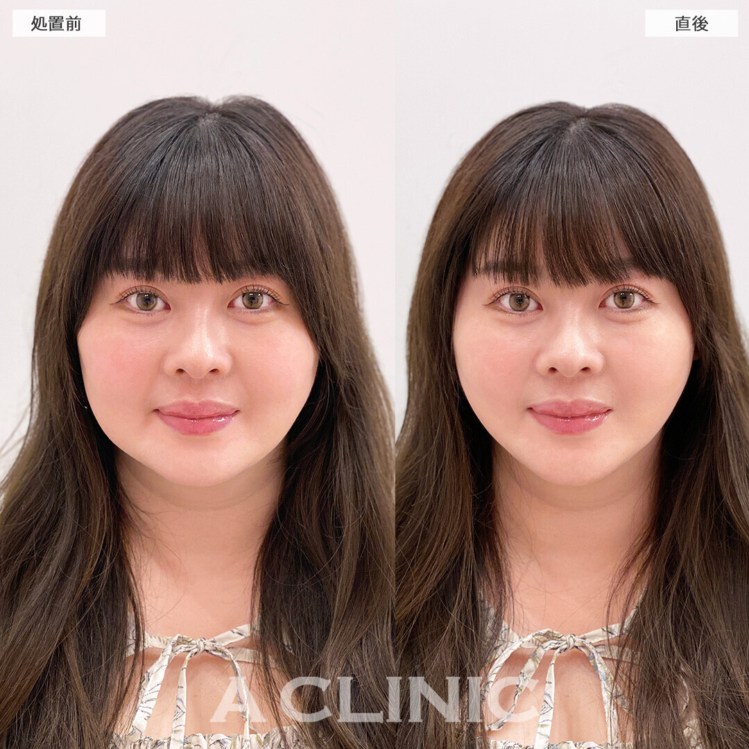 Aスレッドで口横のたるみがしっかりリフトアップ！こちら処置前と直後の症例です(30代女性)