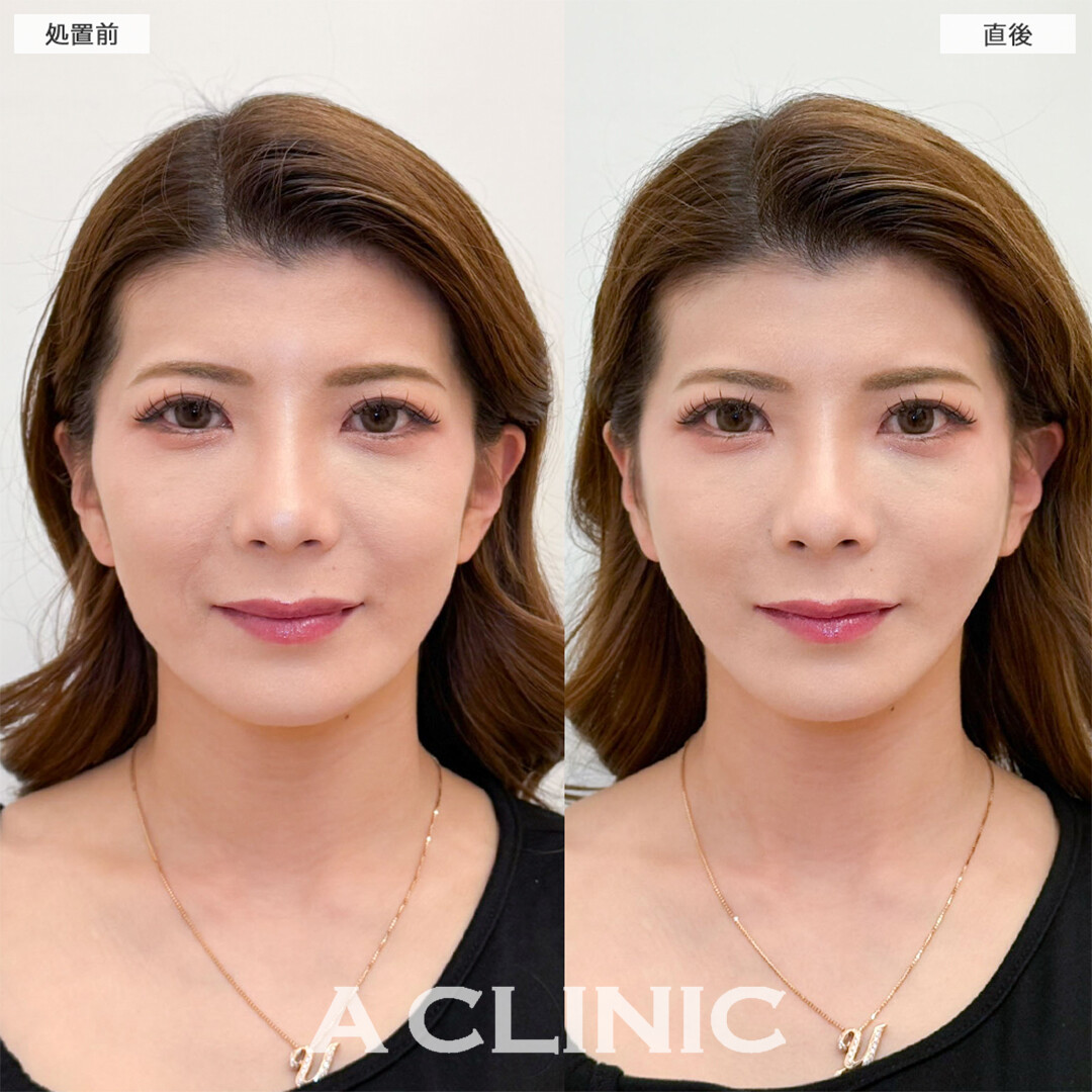 Aスレッドでほうれい線が消え笑顔に自信がつきました！こちら処置前と直後の症例です(30代女性)