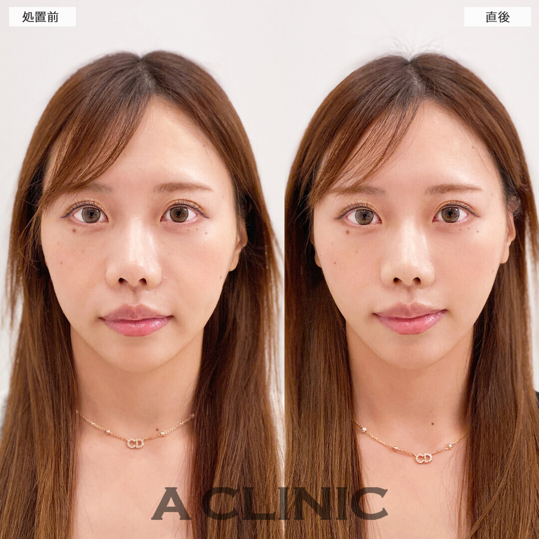 Aスレッドなら将来のたるみ予防にも効果的です！処置前と直後の症例です(30代女性)