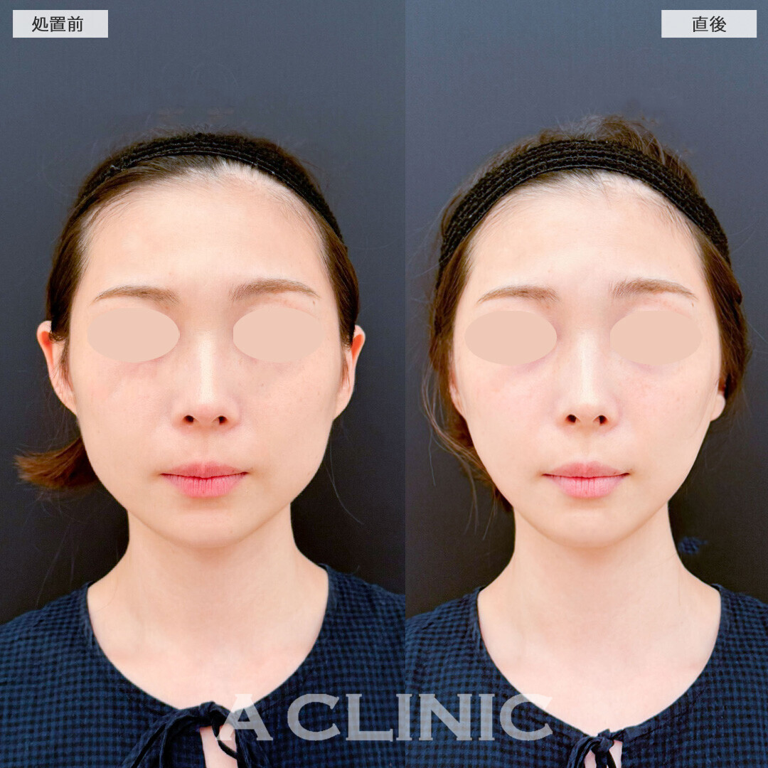 Aスレッドならナチュラルにリフトアップが叶います！こちら処置前と直後の症例です(20代女性)