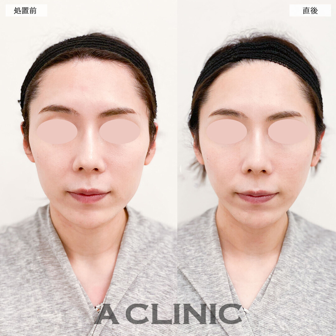 Aスレッドでリフトアップすることで中顔面も短く見えます！こちら処置前と直後の症例です(30代女性)