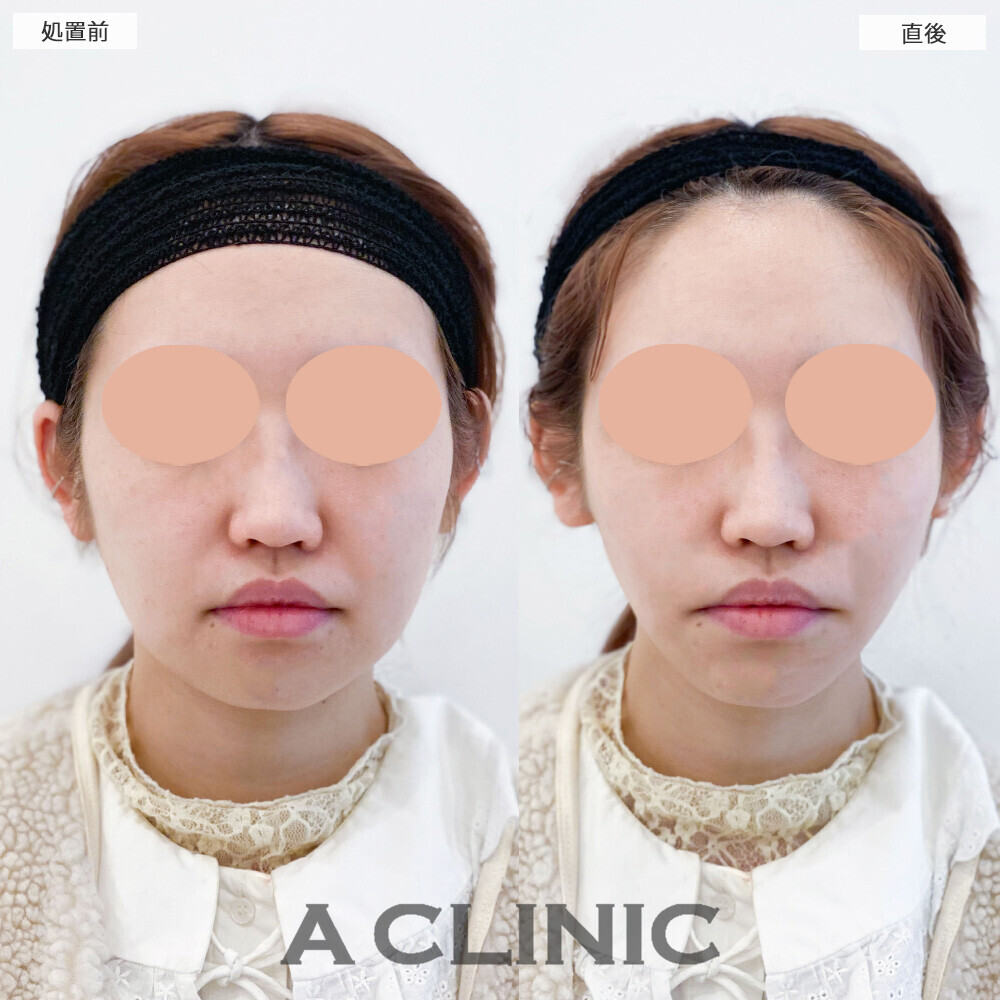 Aスレッドで重たい印象に見えていた口横のたるみが改善！こちら処置前と直後の症例です(20代女性)