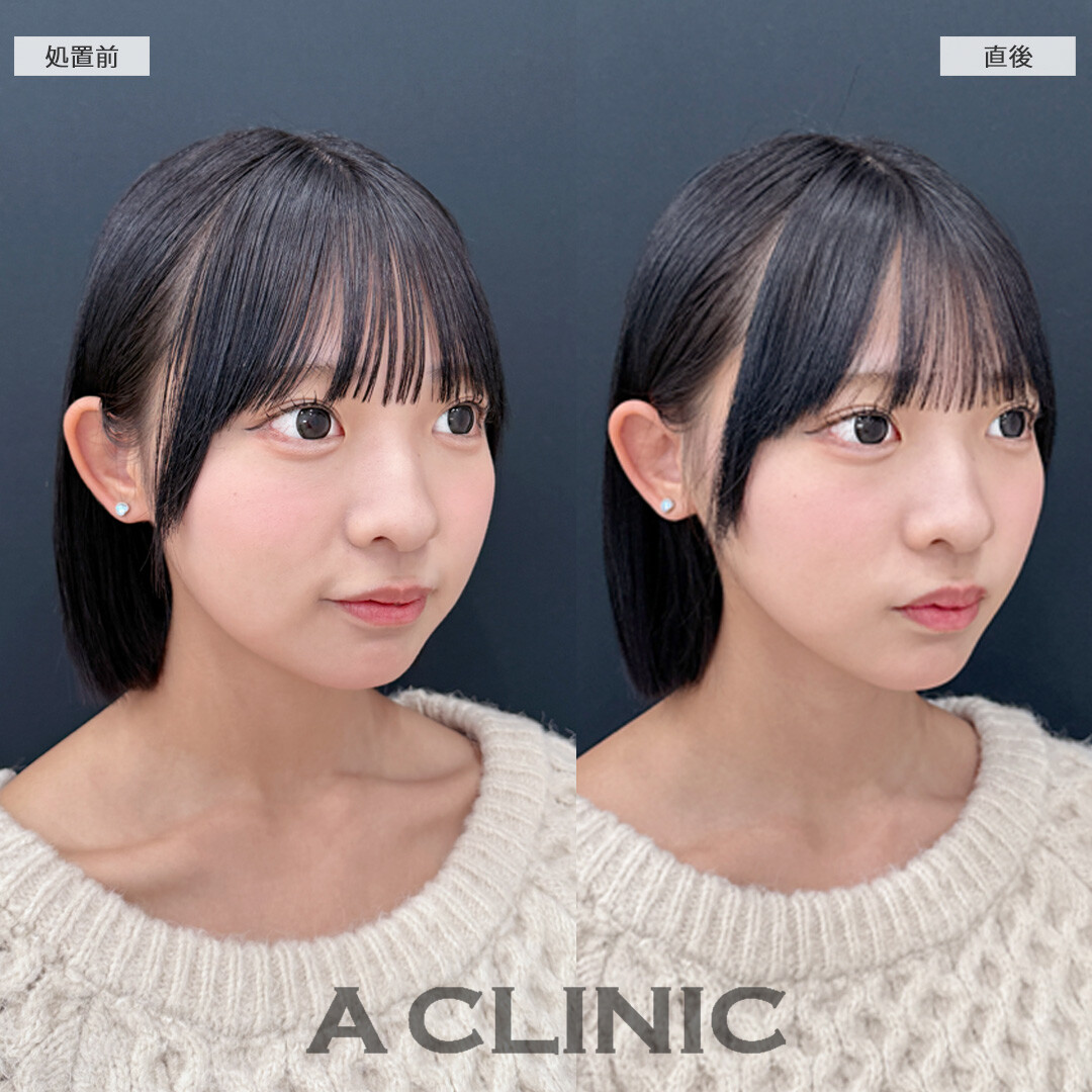 直後から丸顔感が緩和されて超スッキリ！こちらAスレッドの処置前と直後の症例です(10代女性)