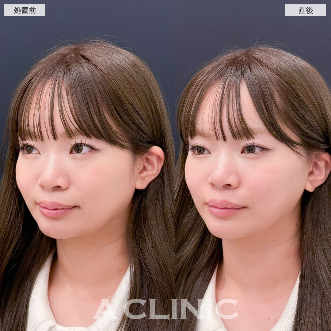 Aスレッドとヒアルロン酸注射(シワ)で輪郭の左右差とマリオネットラインを同時に改善！こちら処置前と直後の症例です(20代女性)