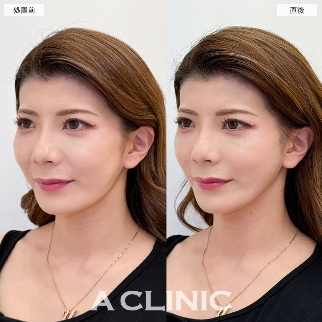 Aスレッドでほうれい線が消え笑顔に自信がつきました！こちら処置前と直後の症例です(30代女性)