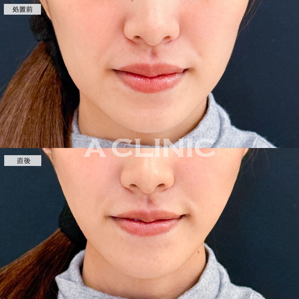 Aスレッドで輪郭のボコつきが整いました！こちら処置前と直後の症例です(20代女性)