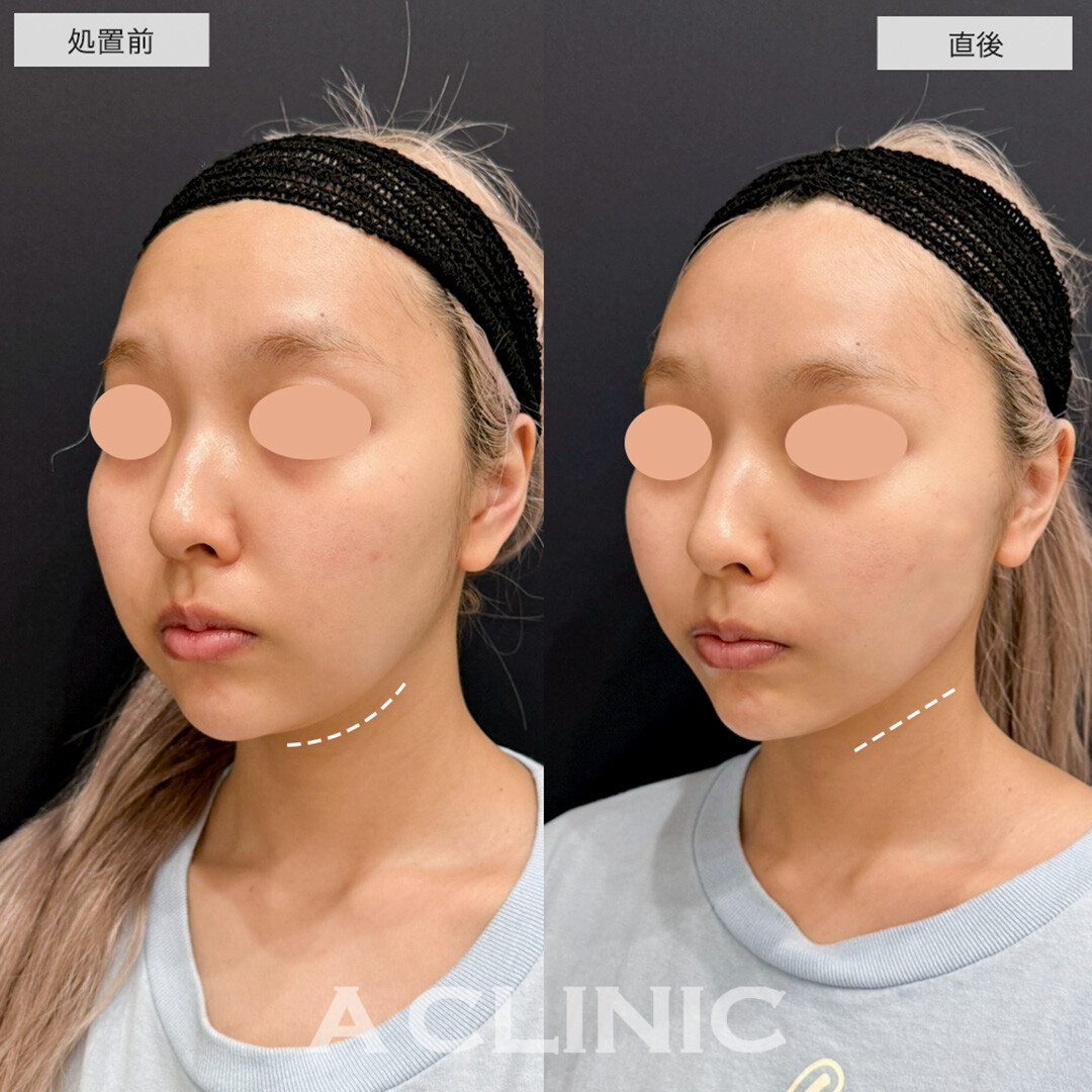 Aスレッドとヒアルロン酸注射を組み合わせて腫れ最小限で理想の輪郭に!こちら処置前と直後の症例です(20代女性)