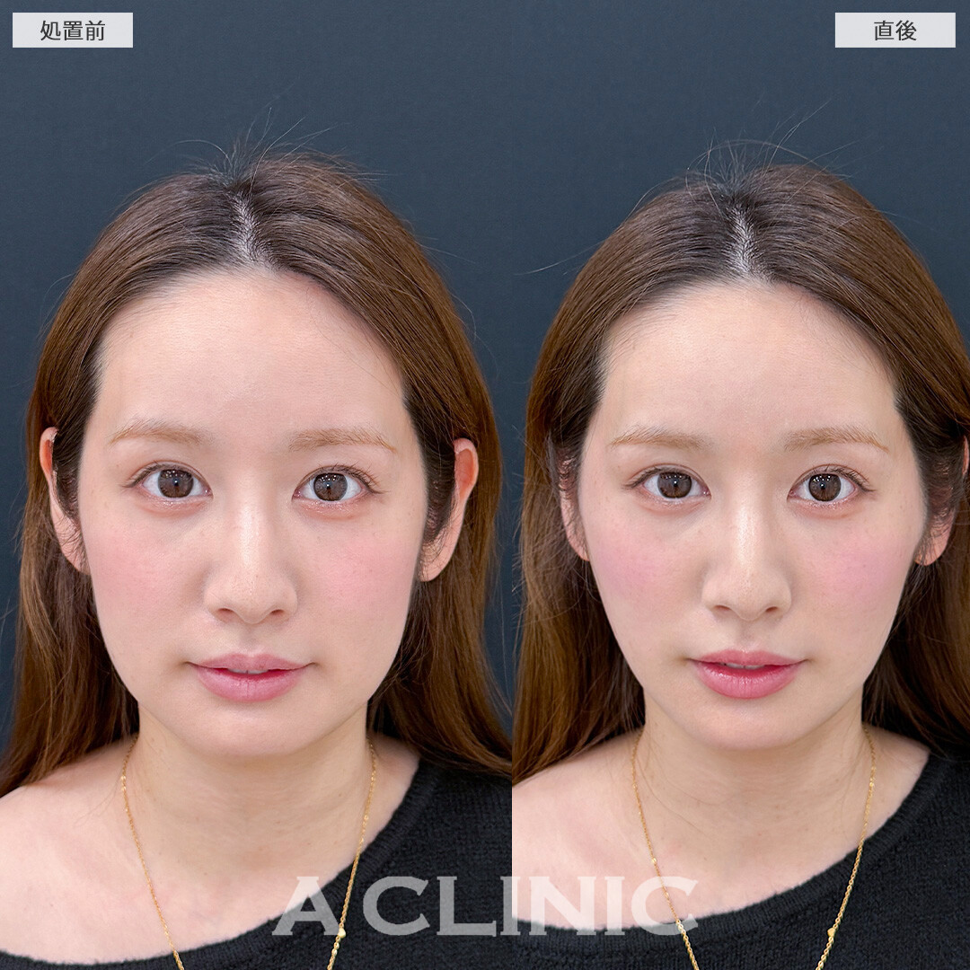 Aスレッドなら少ない本数で強力リフトアップ！こちら処置前と直後の症例です(30代女性)