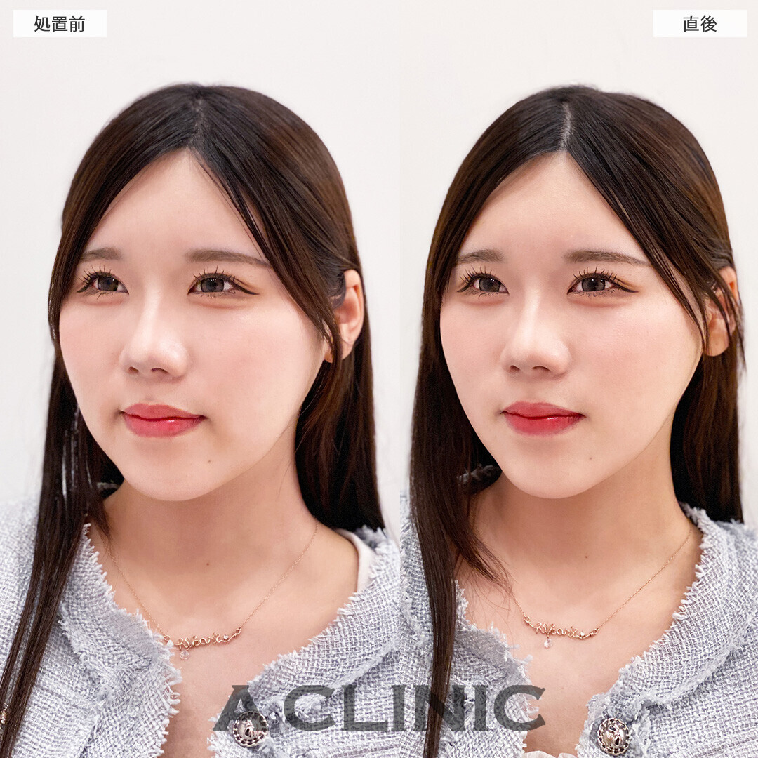 Aスレッドで理想通りのVフェイスになれました！処置前と直後の症例です(20代女性)