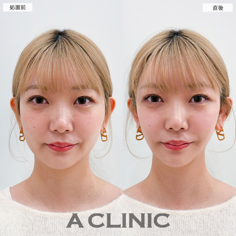 Aスレッドでリフトアップすることでより小顔になりました！こちら処置前と直後の症例です(20代女性)