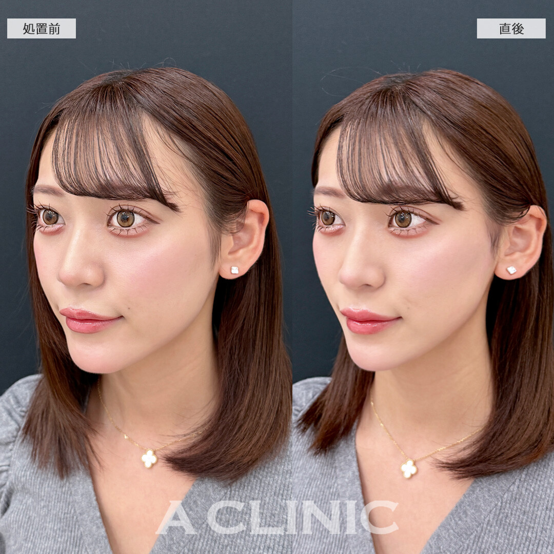 Aスレッドで口元のもたつきが直後からスッキリ！こちら処置前と直後の症例です(20代女性)