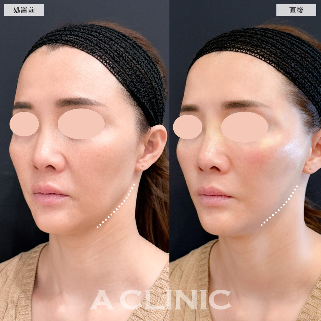 Aスレッドでもたつきなくして理想のフェイスラインへ！こちら処置前と直後の症例です(40代女性)