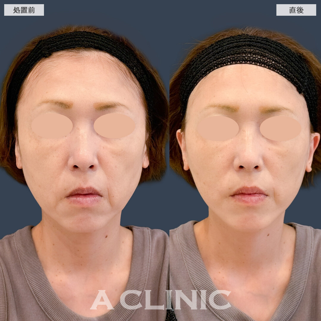 Aスレッドはダウンタイム少なくしわを引き上げアンチエイジング効果が期待できます！こちら処置前と直後の症例です(40代女性)