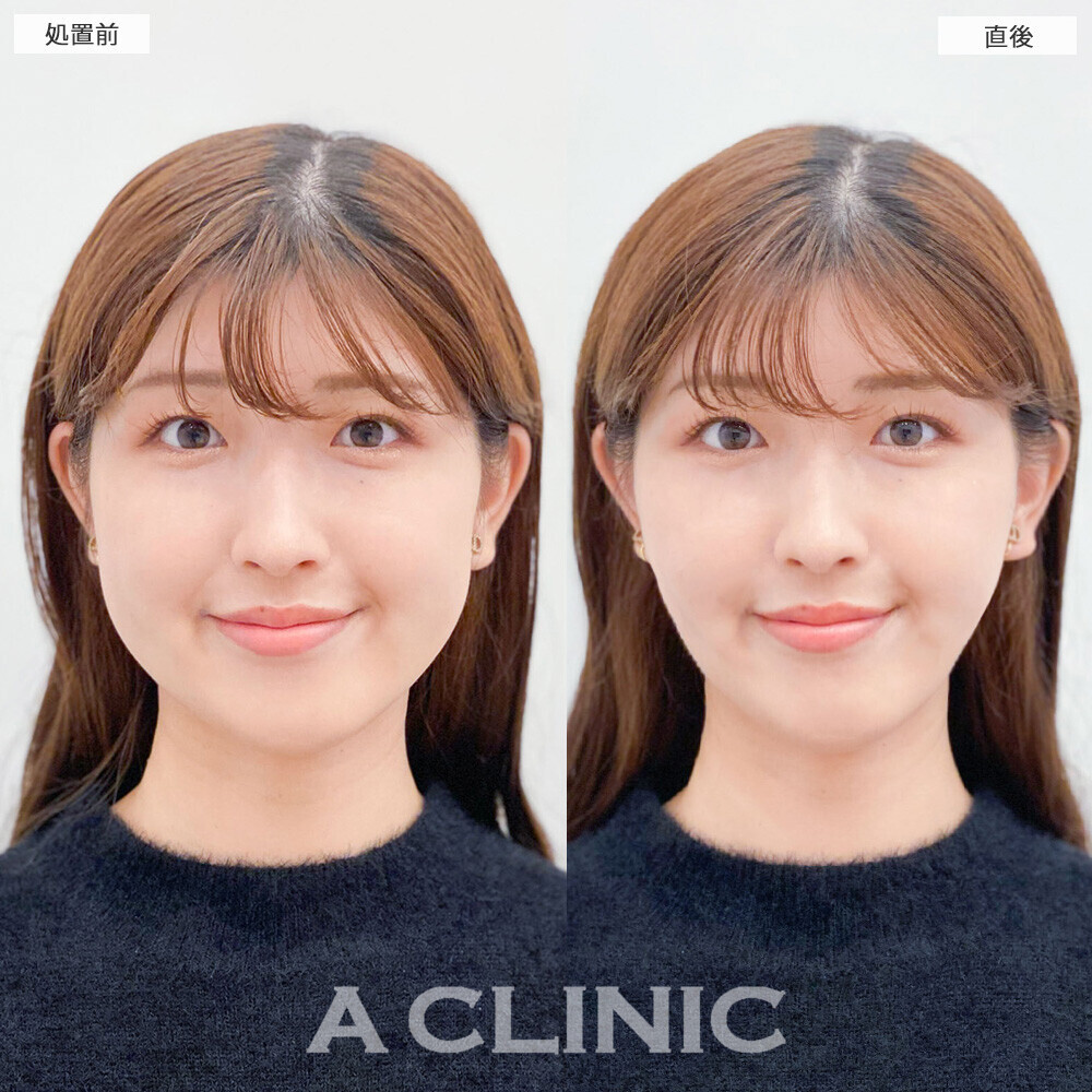 Aスレッドで顔の余白を無くしてバランスの良いお顔に！こちら処置前と直後の症例です(20代女性)