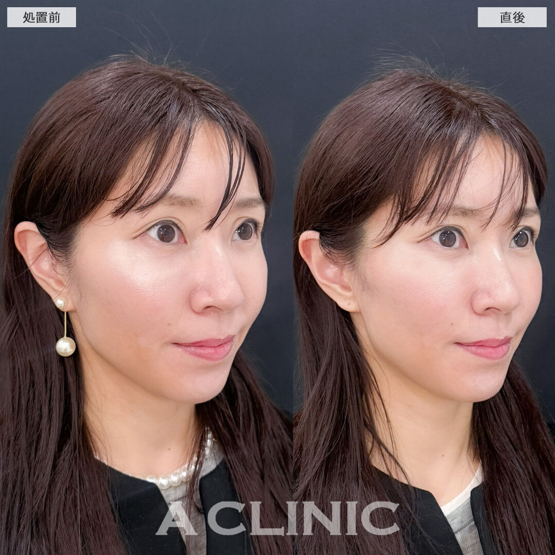 Aスレッドで気になってきたたるみも即引き上げ理想の小顔に！こちら処置前と直後の症例です(30代女性)