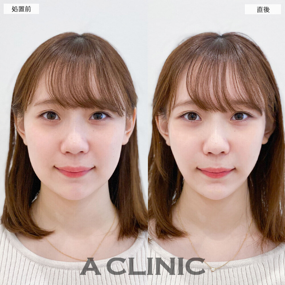 Aスレッドとあごへのヒアルロン酸注入で丸顔から卵型に変化！こちら処置前と直後の症例です(20代女性)