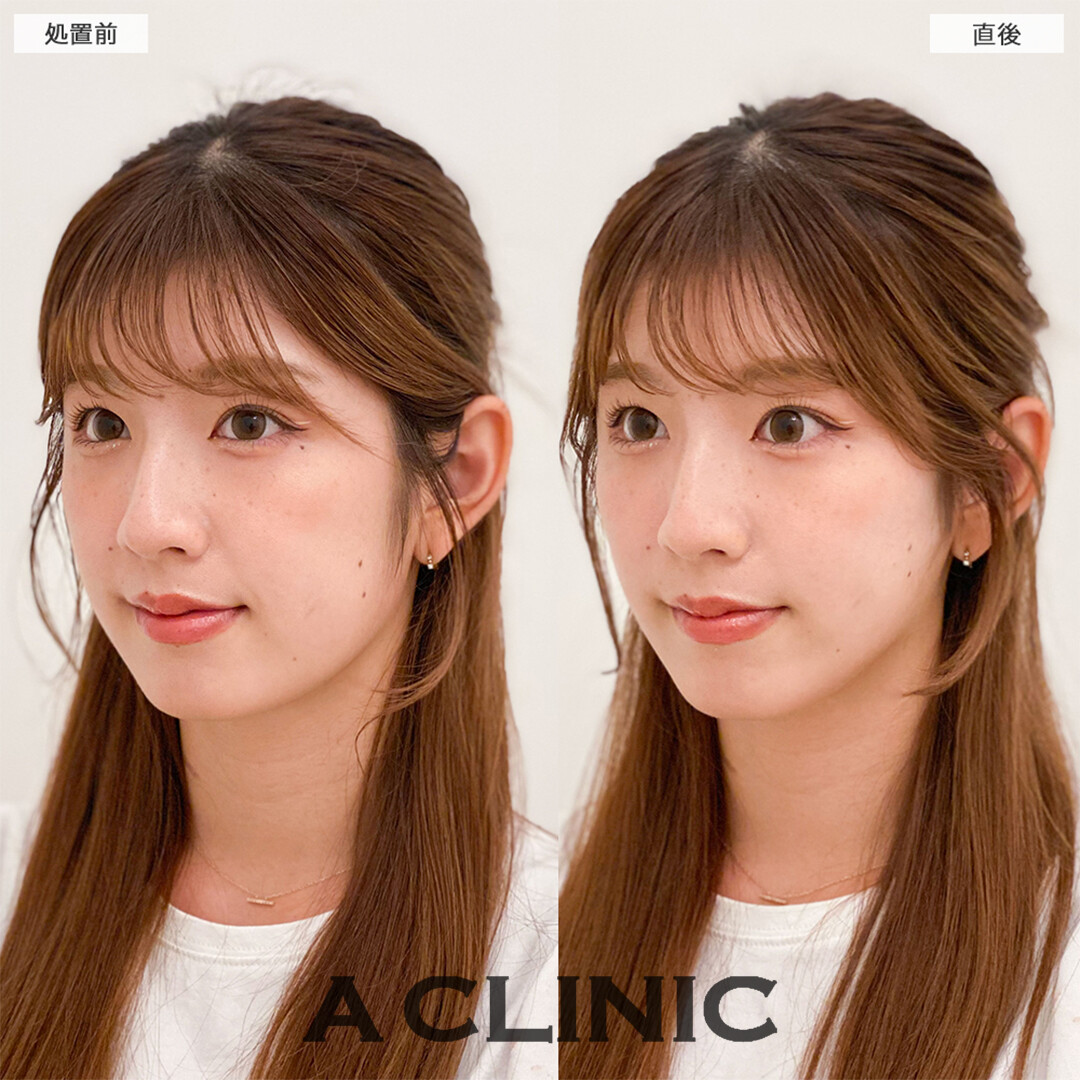 Aスレッドは輪郭の左右差も改善できます！こちら処置前と直後の症例です(20代女性)