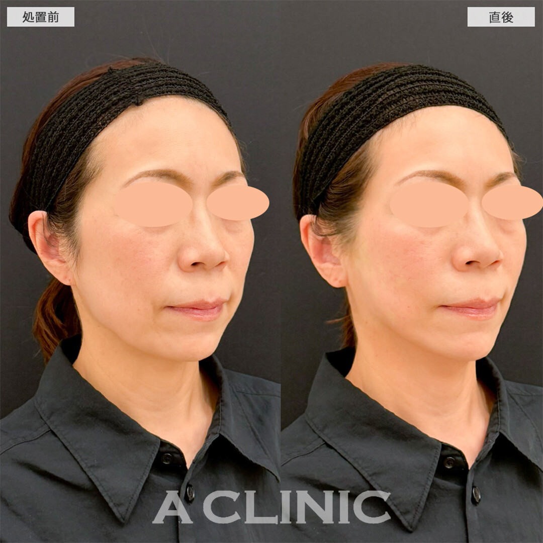 Aスレッドで口横たるみが無くなり綺麗な卵形輪郭へ！こちら処置前と直後の症例です(50代女性)