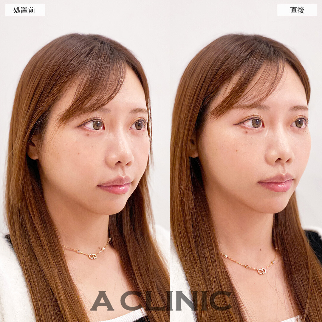 Aスレッドなら将来のたるみ予防にも効果的です！処置前と直後の症例です(30代女性)
