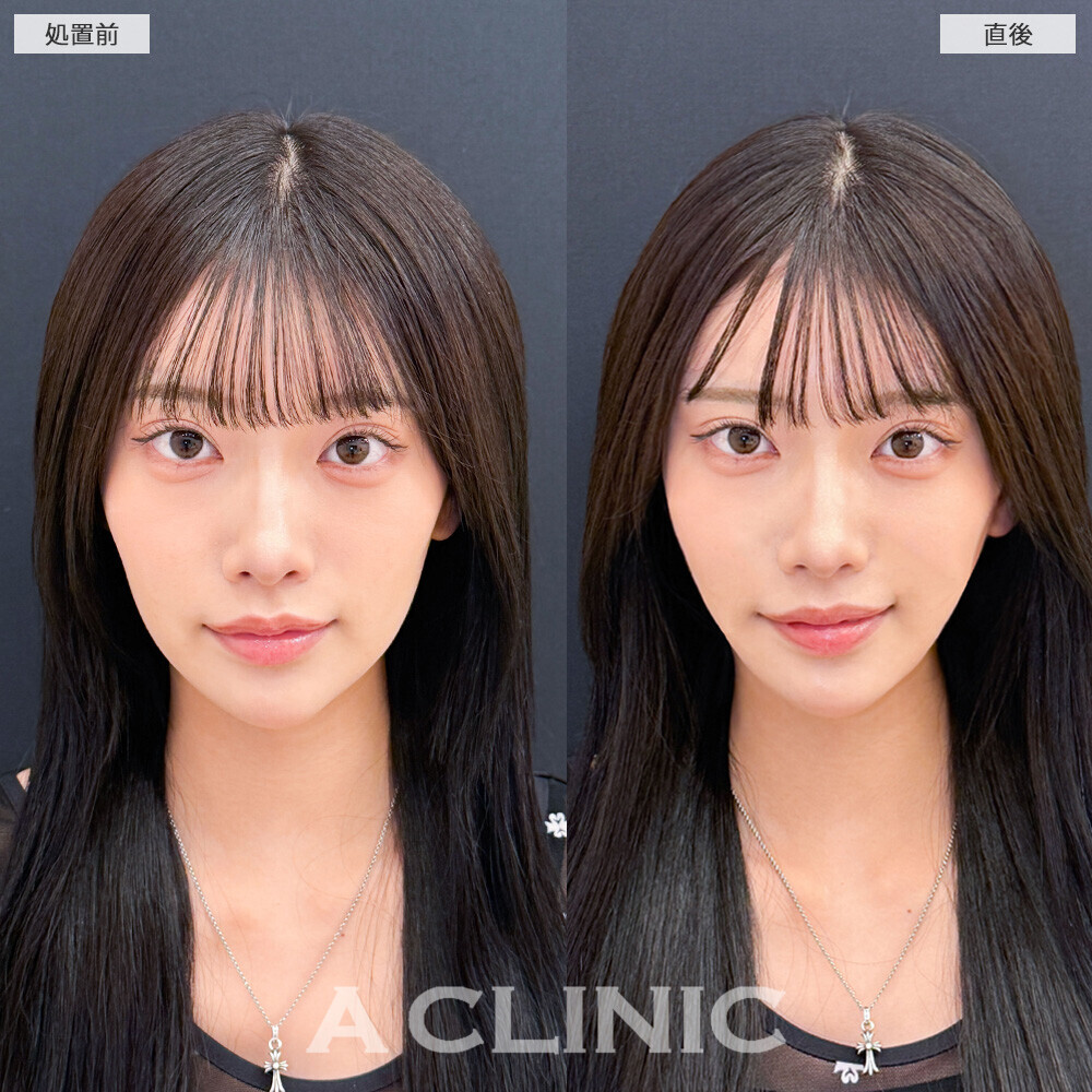 AスレッドでVフェイスになり更に小顔を手に入れました！こちら処置前と直後の症例です(20代女性)