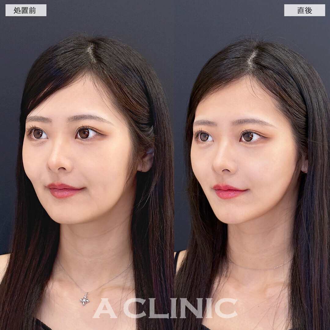 Aスレッドで口横のもたつきがスッキリ改善！こちら処置前と直後の症例です(20代女性)