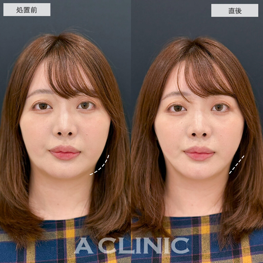 Aスレッドは頬コケせずにリフトアップが可能です!こちら処置前と直後の症例です(30代女性)