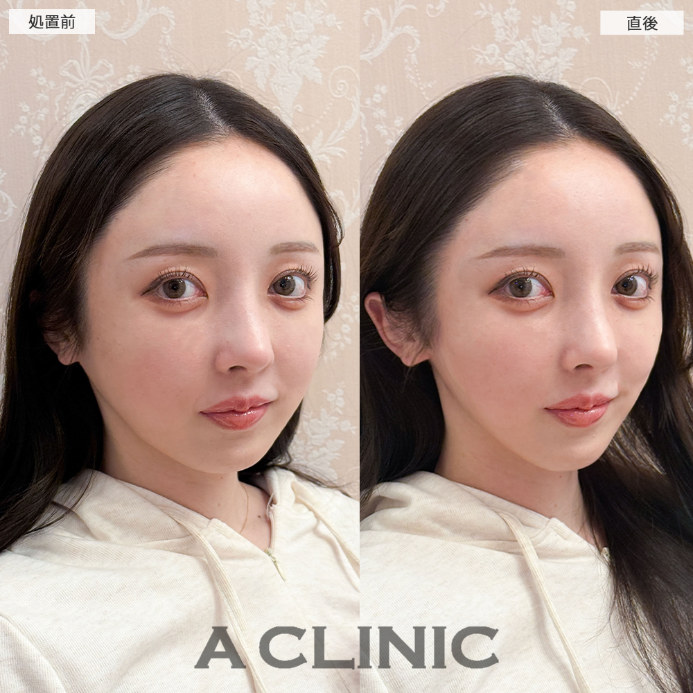 Aスレッドで顔の余白を無くすことでパーツが大きく見えるようになりました！こちら処置前と直後の症例です(20代女性)