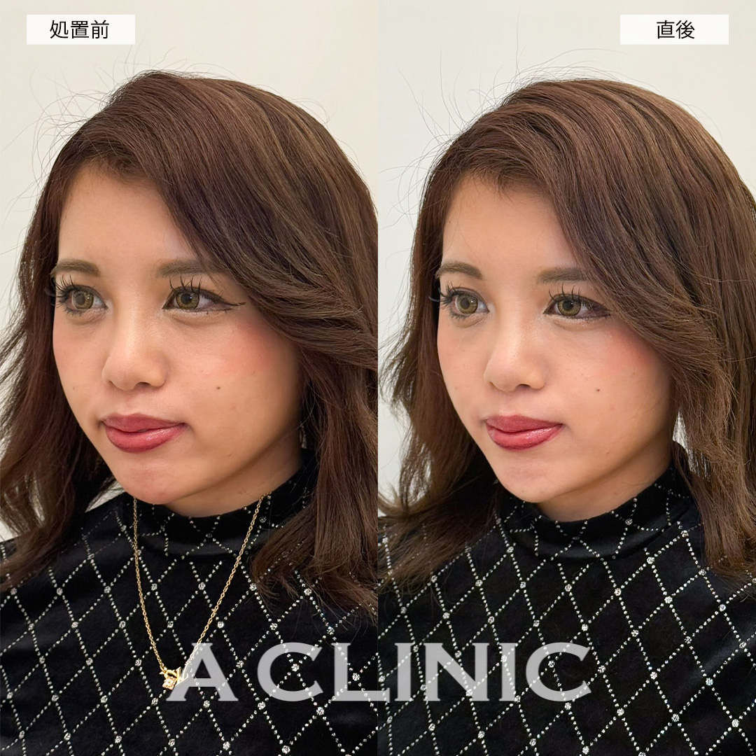 Aスレッドで直後からリフトアップし笑顔に自信が持てるようになりました！こちら処置前と直後の症例です(20代女性)