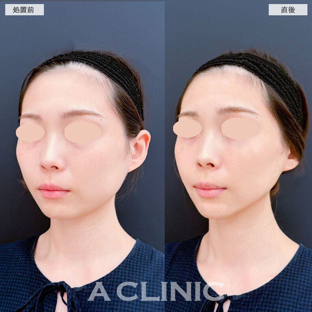 Aスレッドならナチュラルにリフトアップが叶います！こちら処置前と直後の症例です(20代女性)