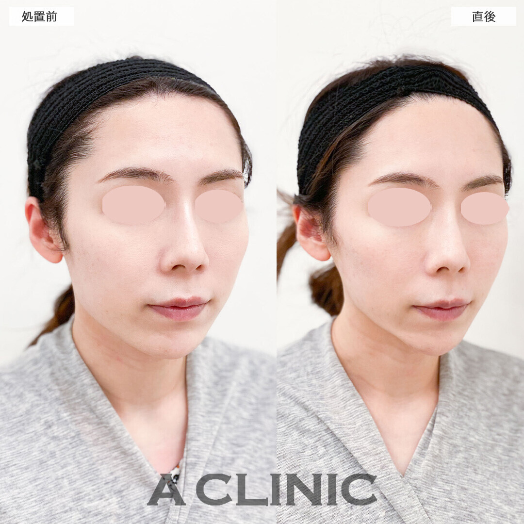 Aスレッドでリフトアップすることで中顔面も短く見えます！こちら処置前と直後の症例です(30代女性)