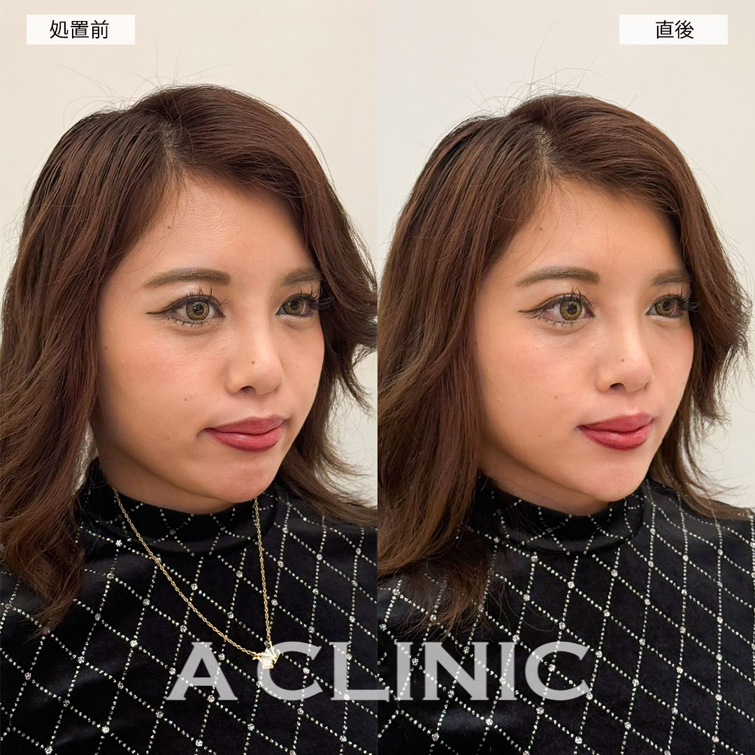 Aスレッドで直後からリフトアップし笑顔に自信が持てるようになりました！こちら処置前と直後の症例です(20代女性)