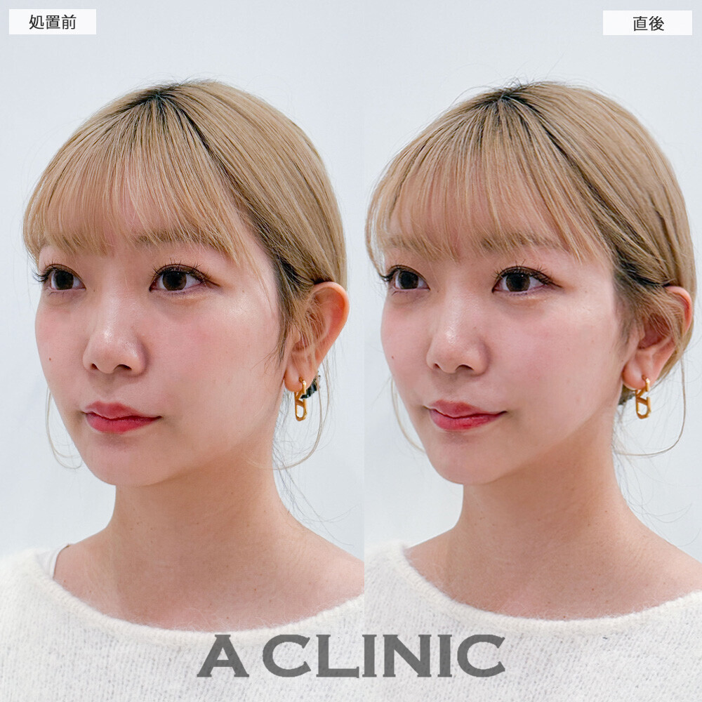 Aスレッドでリフトアップすることでより小顔になりました！こちら処置前と直後の症例です(20代女性)