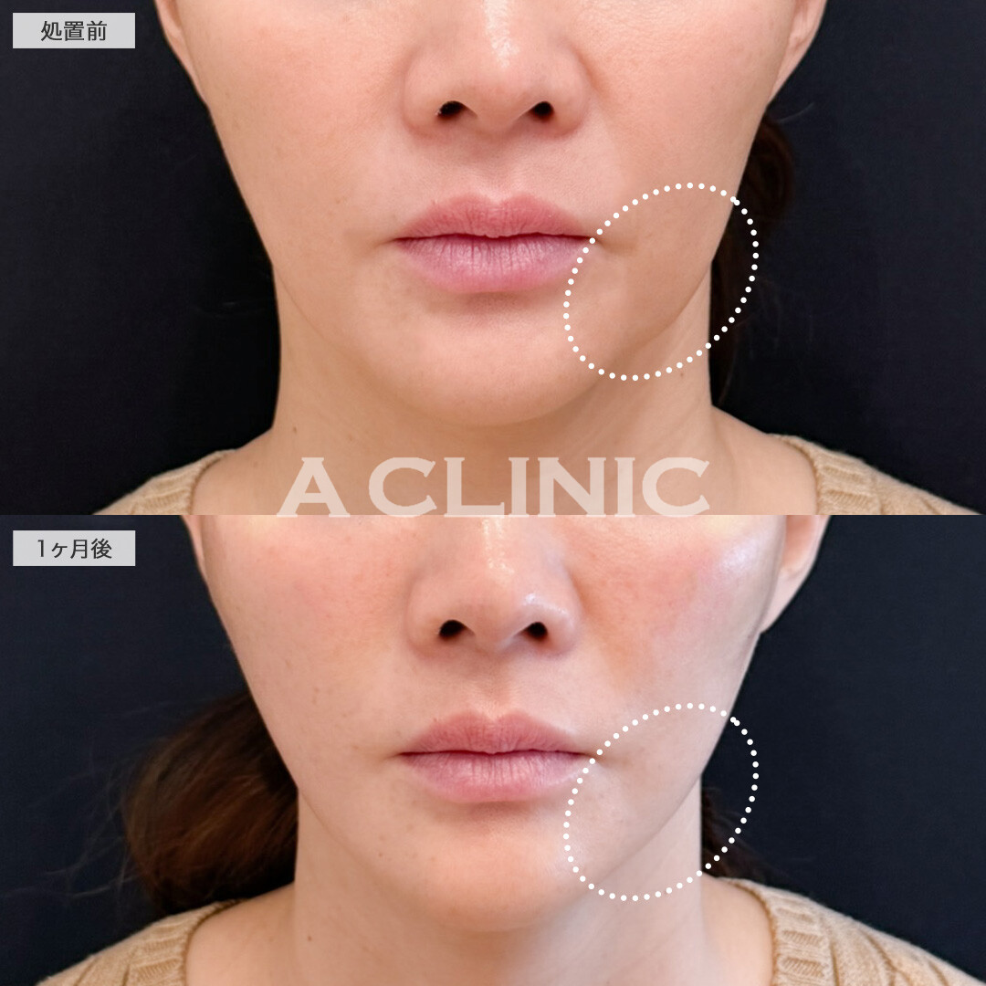 Aスレッドでもたつきなくして理想のフェイスラインへ！こちら処置前と直後の症例です(40代女性)