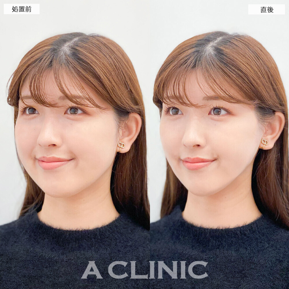 Aスレッドで顔の余白を無くしてバランスの良いお顔に！こちら処置前と直後の症例です(20代女性)