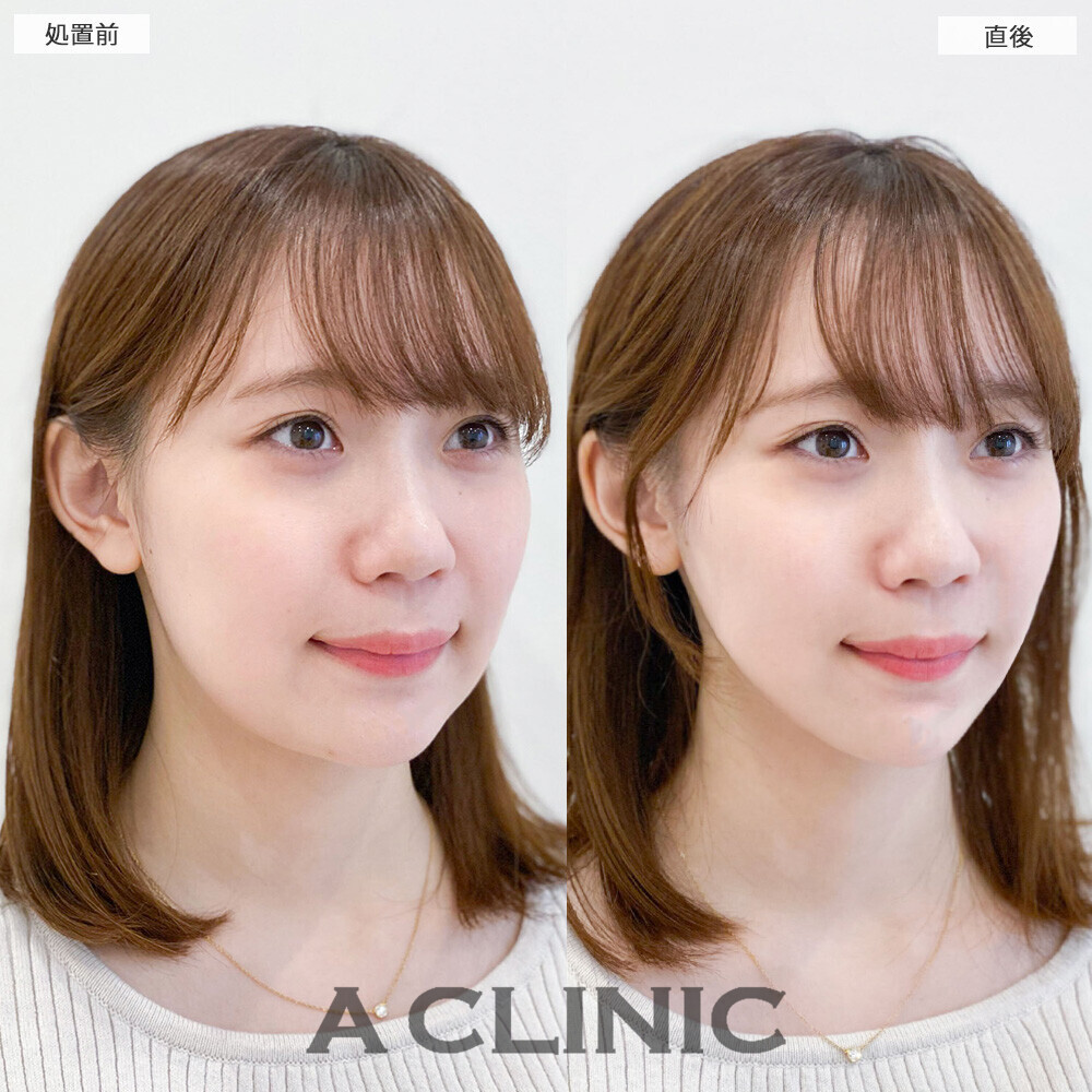 Aスレッドとあごへのヒアルロン酸注入で丸顔から卵型に変化！こちら処置前と直後の症例です(20代女性)