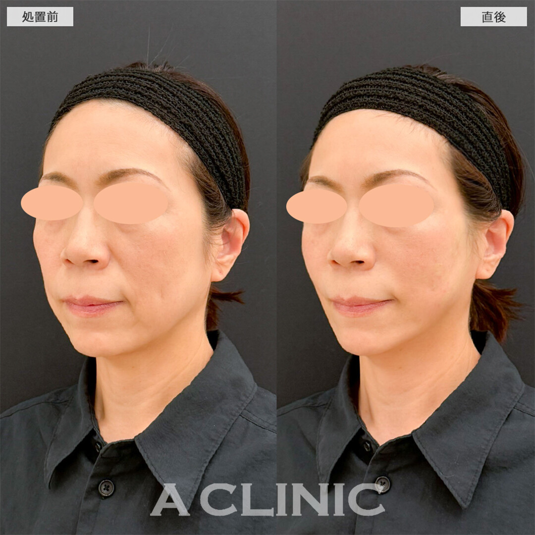 Aスレッドで口横たるみが無くなり綺麗な卵形輪郭へ！こちら処置前と直後の症例です(50代女性)