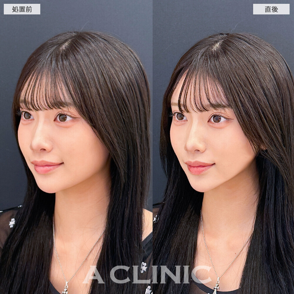 AスレッドでVフェイスになり更に小顔を手に入れました！こちら処置前と直後の症例です(20代女性)