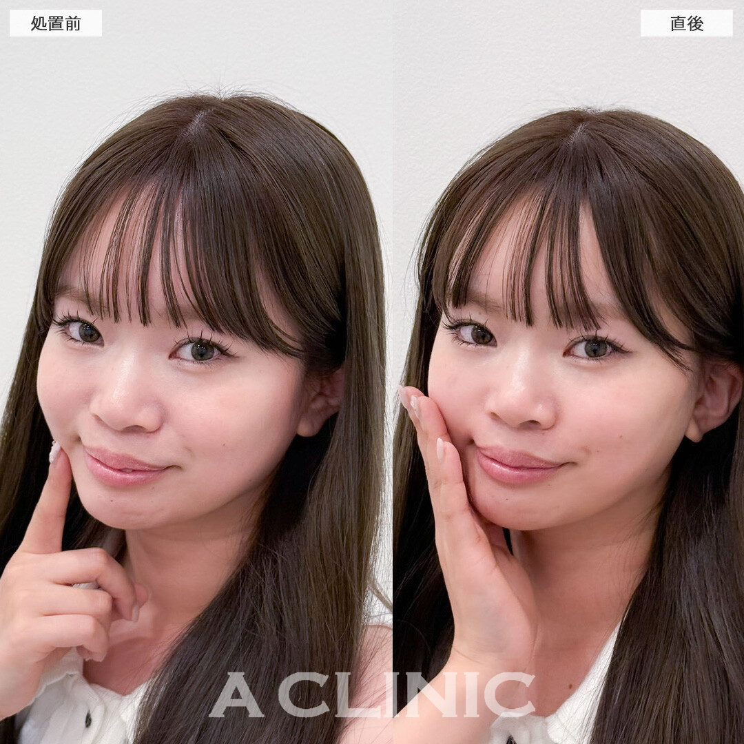 Aスレッドとヒアルロン酸注射(シワ)で輪郭の左右差とマリオネットラインを同時に改善！こちら処置前と直後の症例です(20代女性)