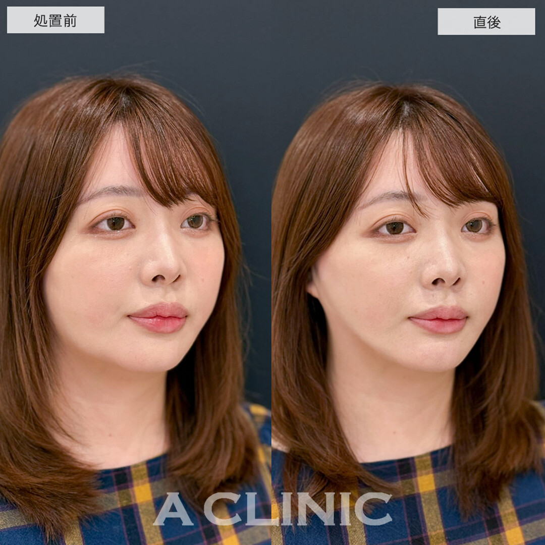 Aスレッドは頬コケせずにリフトアップが可能です!こちら処置前と直後の症例です(30代女性)