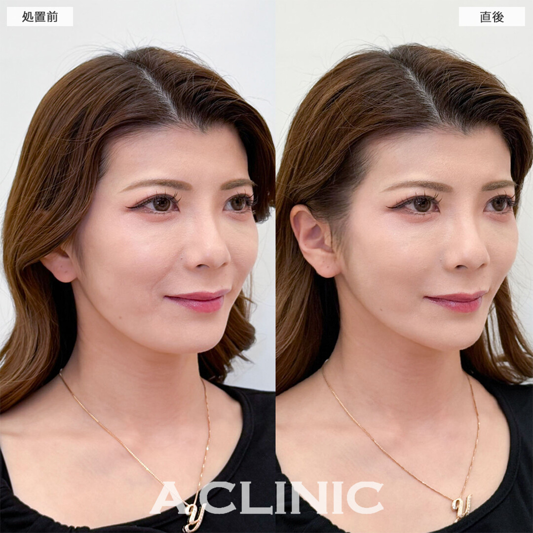 Aスレッドでほうれい線が消え笑顔に自信がつきました！こちら処置前と直後の症例です(30代女性)