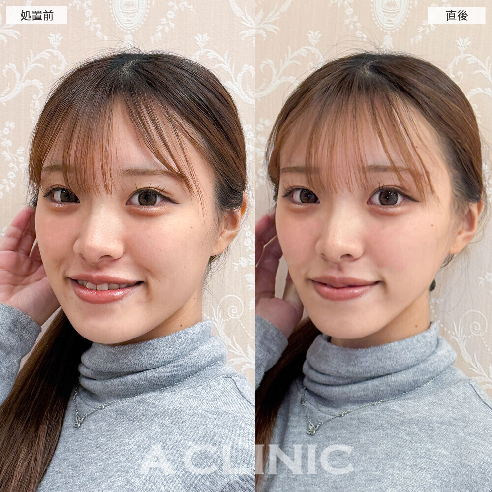 Aスレッドで輪郭のボコつきが整いました！こちら処置前と直後の症例です(20代女性)