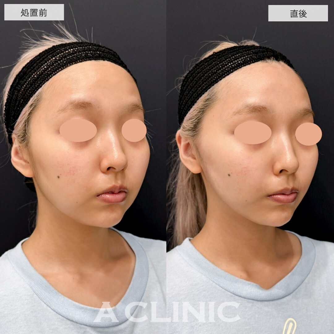 Aスレッドとヒアルロン酸注射を組み合わせて腫れ最小限で理想の輪郭に!こちら処置前と直後の症例です(20代女性)