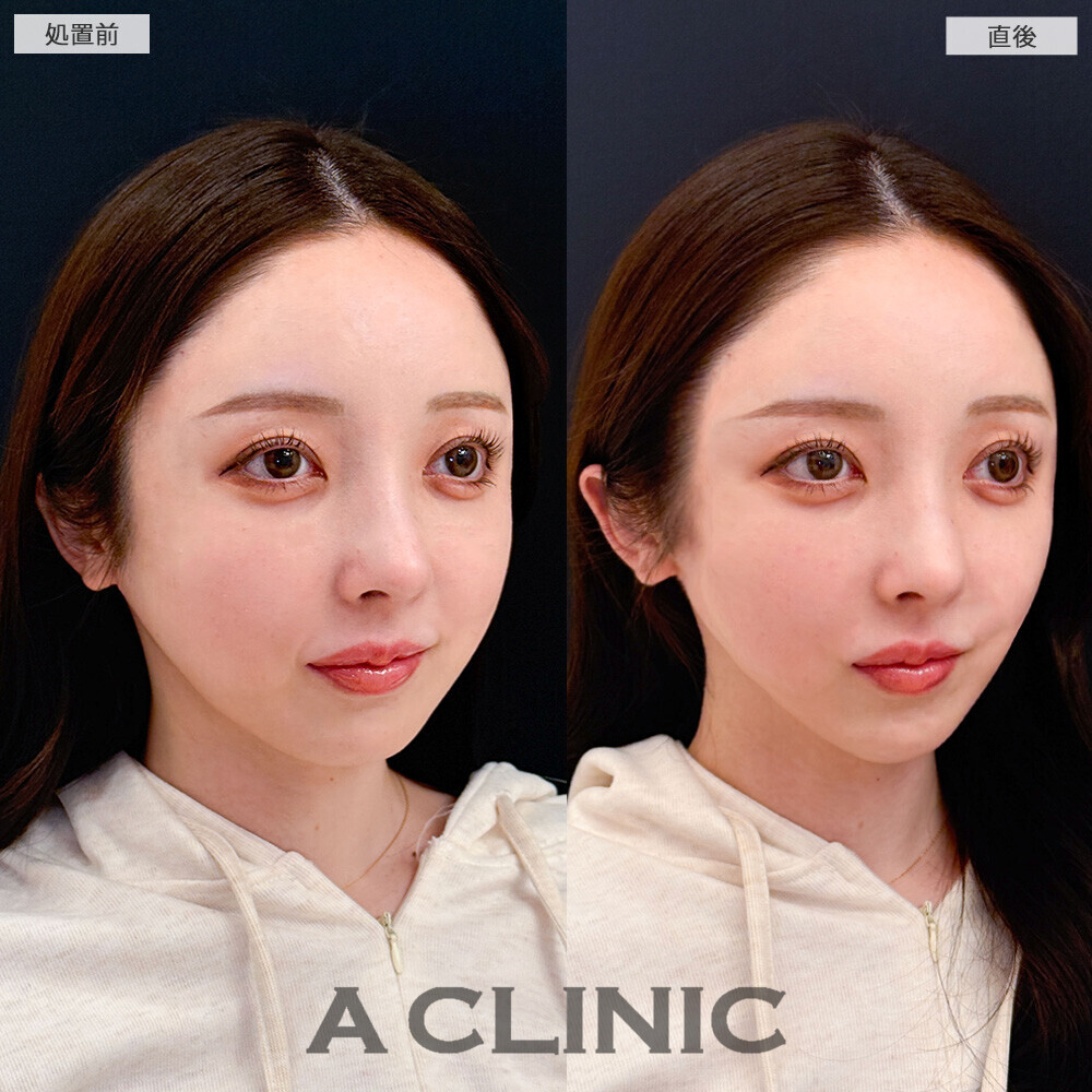 Aスレッドで顔の余白を無くすことでパーツが大きく見えるようになりました！こちら処置前と直後の症例です(20代女性)