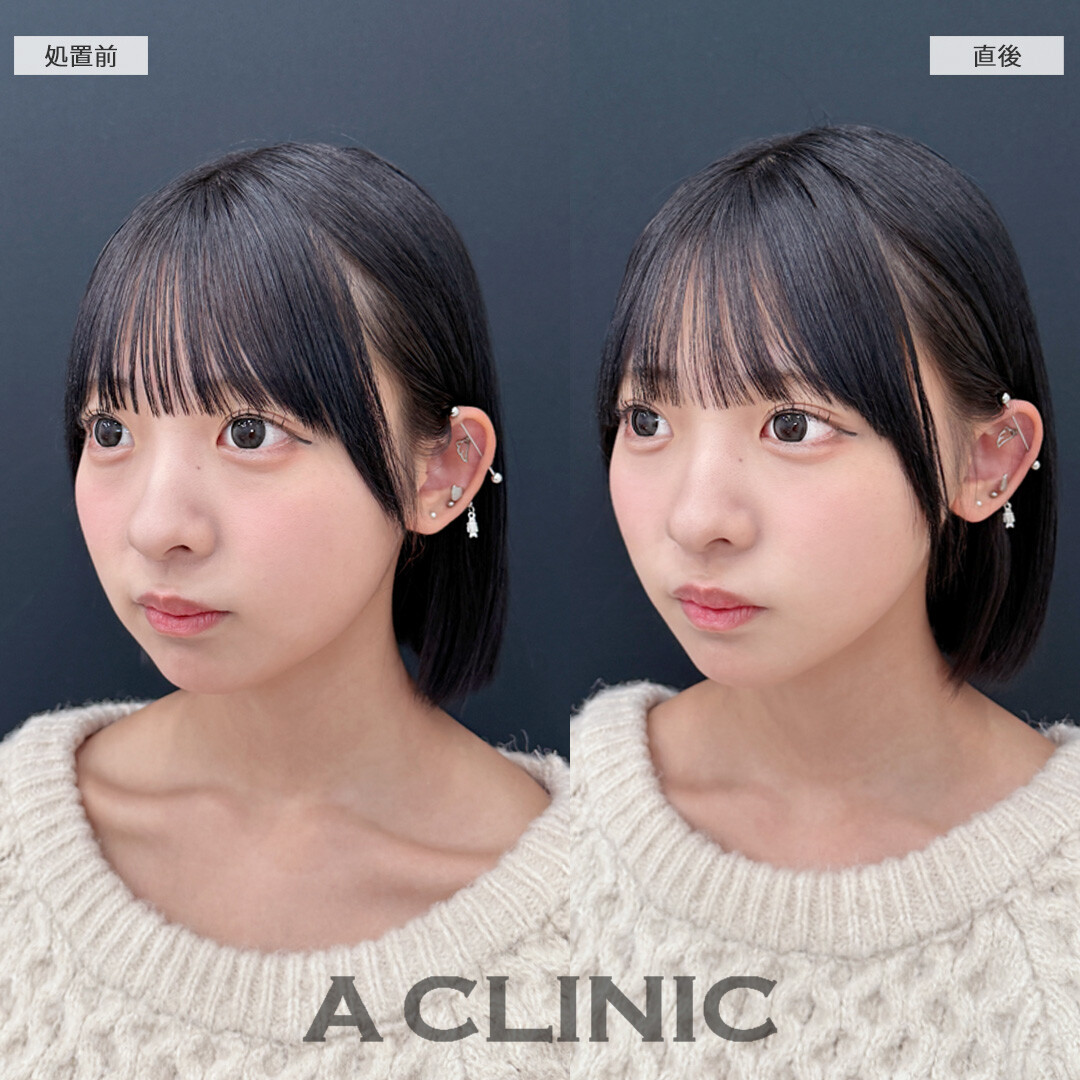直後から丸顔感が緩和されて超スッキリ！こちらAスレッドの処置前と直後の症例です(10代女性)