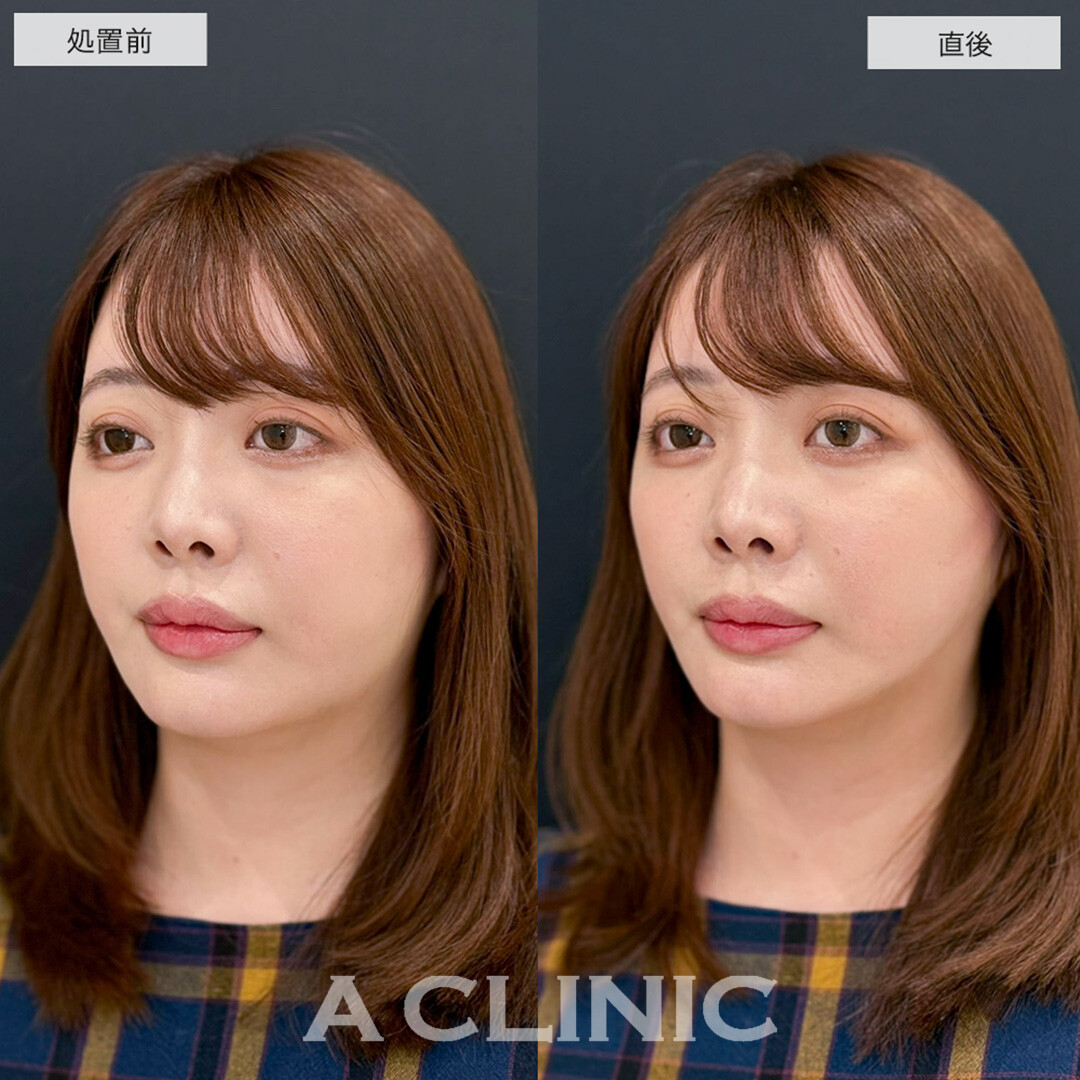 Aスレッドは頬コケせずにリフトアップが可能です!こちら処置前と直後の症例です(30代女性)