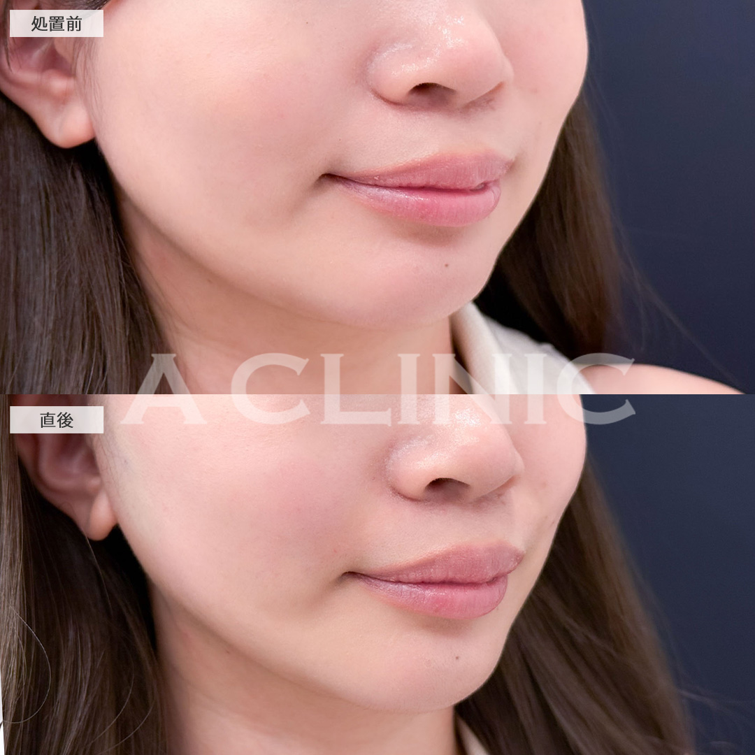 Aスレッドとヒアルロン酸注射(シワ)で輪郭の左右差とマリオネットラインを同時に改善！こちら処置前と直後の症例です(20代女性)